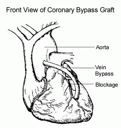 Coronary Artery Bypass Graf