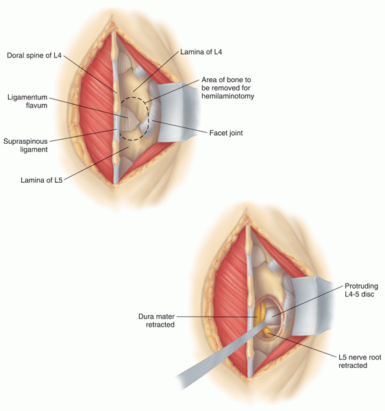 Lumbar Discectomy