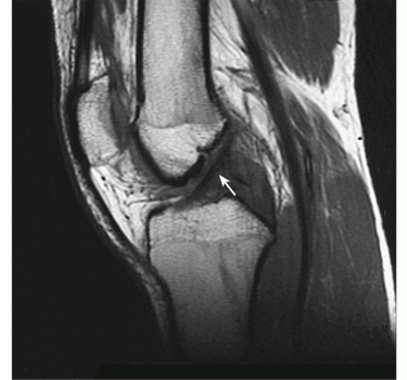  An MRI image of a normal knee