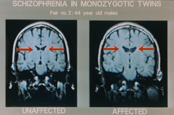 Schizophrenia MRI Scans 1)