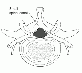 Spinal Stenosis Small Spin